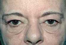 Blepharoplasty before and after Pictures - Eyelid Surgery