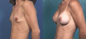 Breast Augmentation Before and After Picture 1