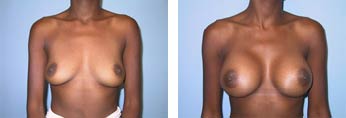 Breast Augmentation Before and After Picture 4