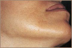 Laser Hair Removal Before and After Picture 2