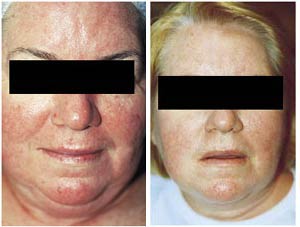 Microdermabrasion Before and After Pictures