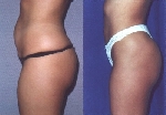 Liposuction Before and After Pictures