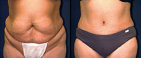 Tummy Tuck Before and After Pictures