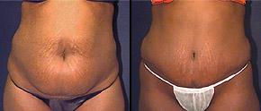 Tummy Tuck Before and After Pictures