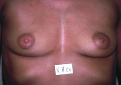Ahmet R. Karaca M.D. Before and After Breast Pictures