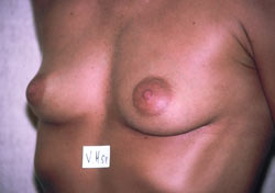 Ahmet R. Karaca M.D. Breast Before and After Pictures