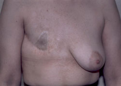 Ahmet R. Karaca, M.D. Breast Before and After Pictures