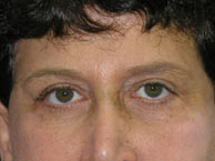 Ahmet R. Karaca, M.D. Before and After Eyelid Surgery Pictures