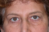 Ahmet R. Karaca M.D. Eyelid Surgery Before and After Pictures