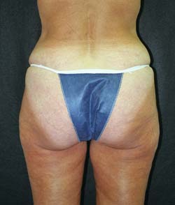 Ahmet R. Karaca, M.D. Liposuction Before and After Pictures