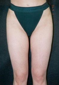Ahmet R. Karaca, M.D. Liposuction Before and After Pictures