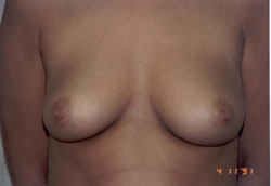 Ahmet R. Karaca, M.D. Before and After Breast Pictures