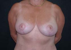 Dr. Ahmet R. Karaca, M.D. Breast Reduction Before and After Pictures