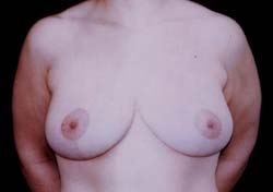 Ahmet R. Karaca, M.D. Before and After Breast Reduction Pictures