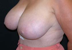 Dr. Ahmet R. Karaca, M.D. Breast Reduction Before and After Pictures