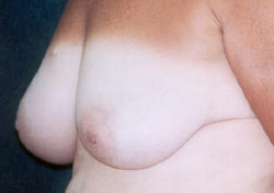 Ahmet R. Karaca M.D. Breast Before and After Pictures