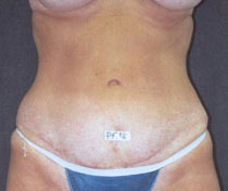 Ahmet R. Karaca, M.D. Before and After Abdominoplasty Pictures