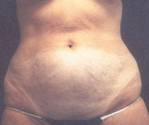 Ahmet R. Karaca, M.D. Before and After Tummy Tuck Pictures