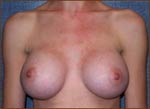 M. Kirk Moore MD Breast Before and After Pictures