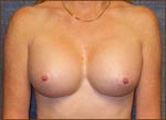 M. Kirk Moore MD Breast Before and After Pictures