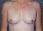 M. Kirk Moore, MD Breast Before and After Pictures