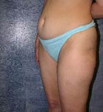M. Kirk Moore MD Liposuction Before and After Pictures