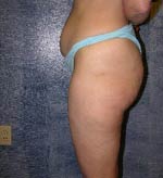M. Kirk Moore MD Liposuction Before and After Pictures