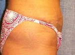 M. Kirk Moore MD Abdominoplasty / Tummy Tuck Before and After Pictures