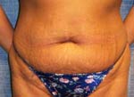 M. Kirk Moore Tummy Tuck / Abdominoplasty Before and After Pictures